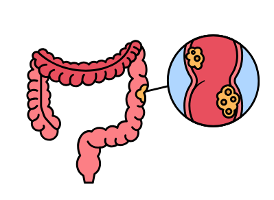 Cáncer colorrectal metastásico: ¿qué significa este diagnóstico?