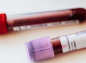 Lupus eritematoso sistémico: ¿cómo leer correctamente sus análisis de sangre?