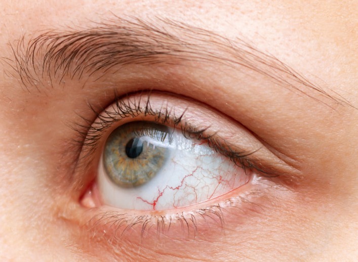 ¿Cuál es la relación entre la enfermedad inflamatoria intestinal crónica (EII) y los trastornos oculares?