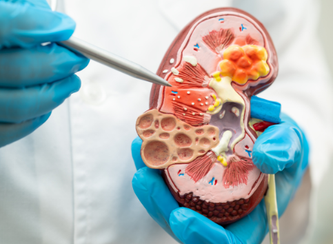 Confusión mental y enfermedad renal crónica: ¿cómo puede afectar la enfermedad a la memoria y al razonamiento?